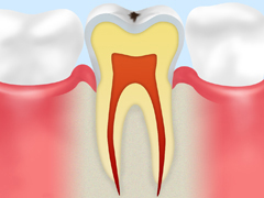 CO 初期むし歯
