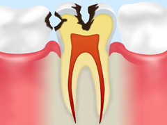 C2 象牙質のむし歯