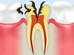 C3 歯の神経のむし歯