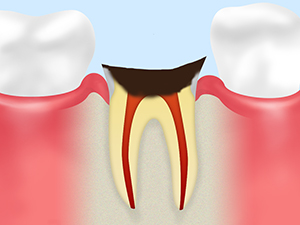 C4 末期むし歯