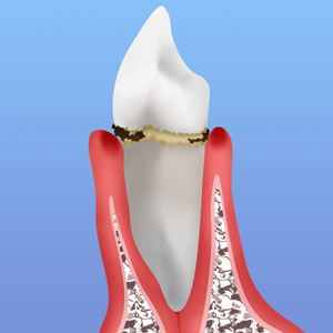 歯肉炎・軽度歯周炎